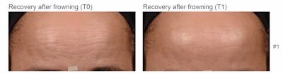 Figure 6 - Representation of measurement of skin resilience on volunteers.