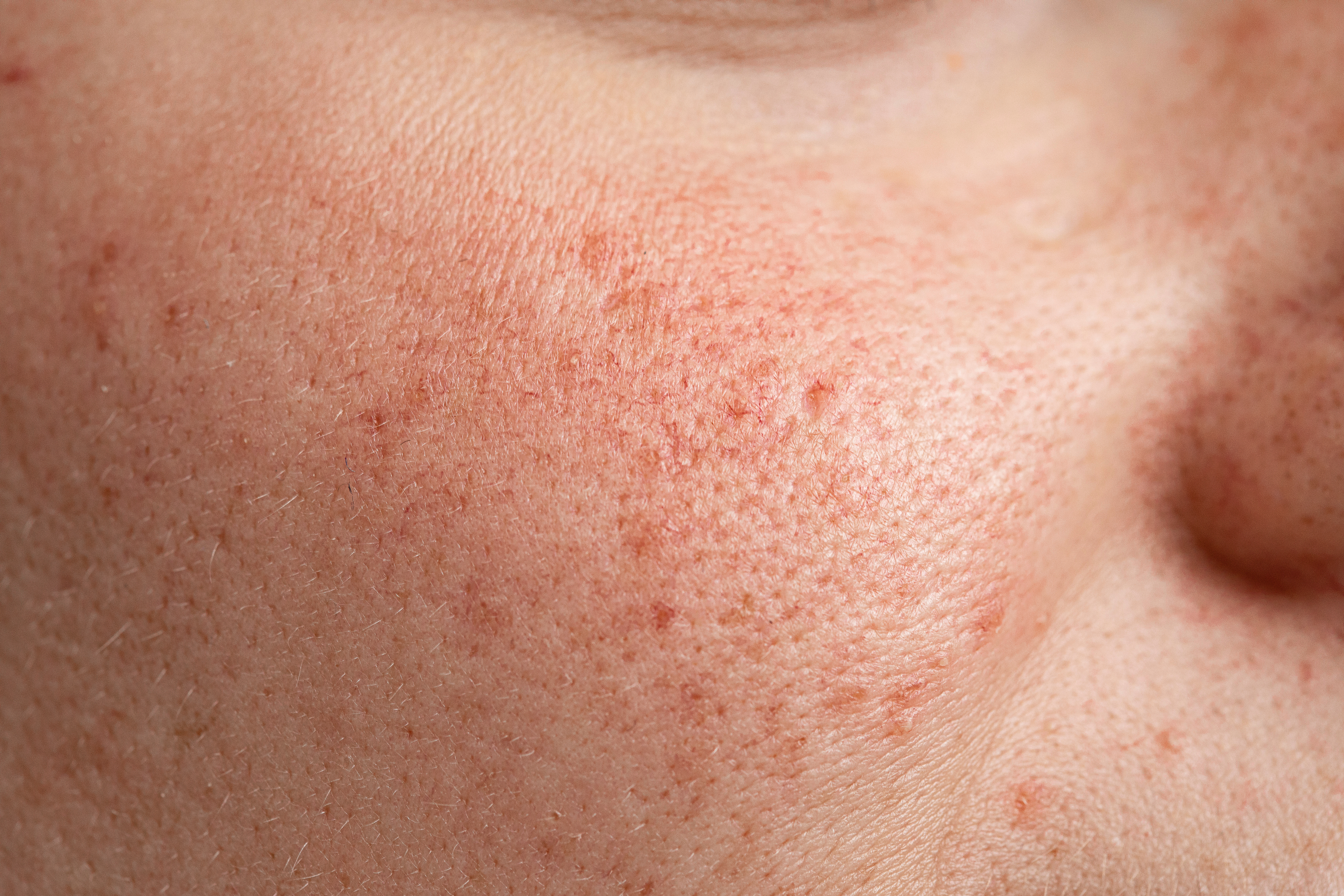 Observed benefits included reduced erythema, dryness and scab formation, indicating improved overall healing quality.