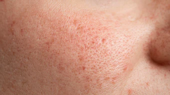 Observed benefits included reduced erythema, dryness and scab formation, indicating improved overall healing quality.