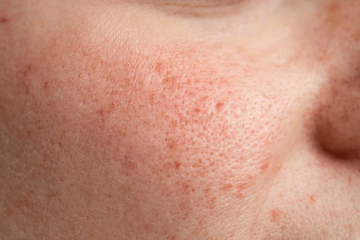 Observed benefits included reduced erythema, dryness and scab formation, indicating improved overall healing quality.