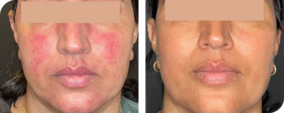 Rosacea